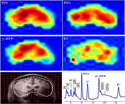 Phosphate Brain Energy Metabolism and Cognition in Alzheimer’s Disease: A Spectroscopy Study Using Whole-Brain Volume-Coil 31Phosphorus Magnetic Resonance Spectroscopy at 7Tesla